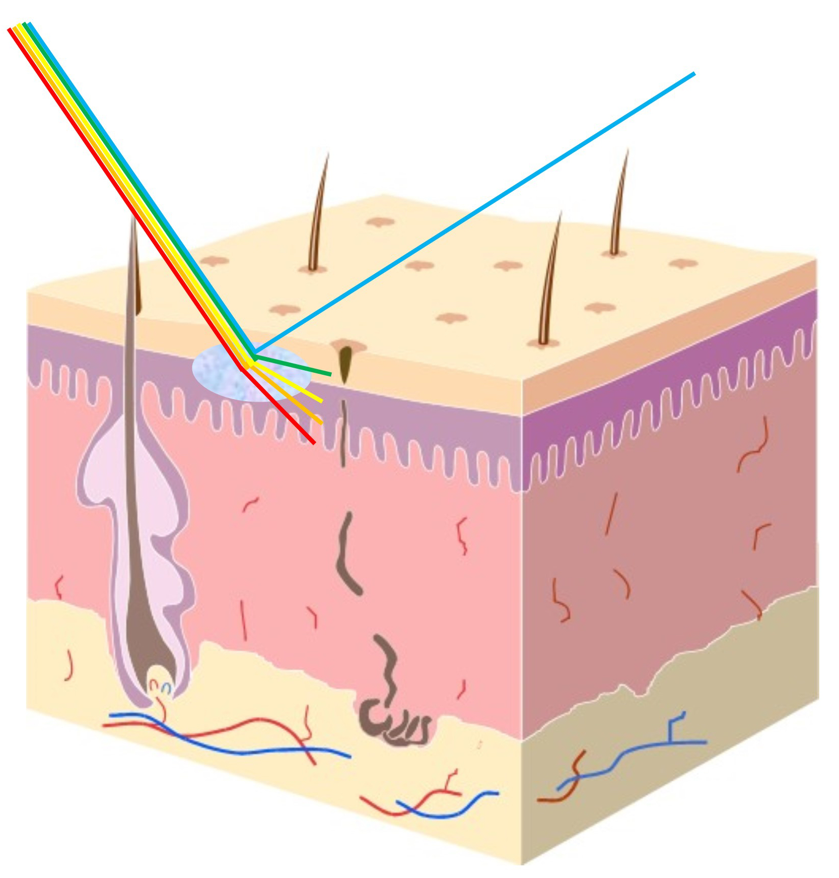 Management of the Tyndall Effect