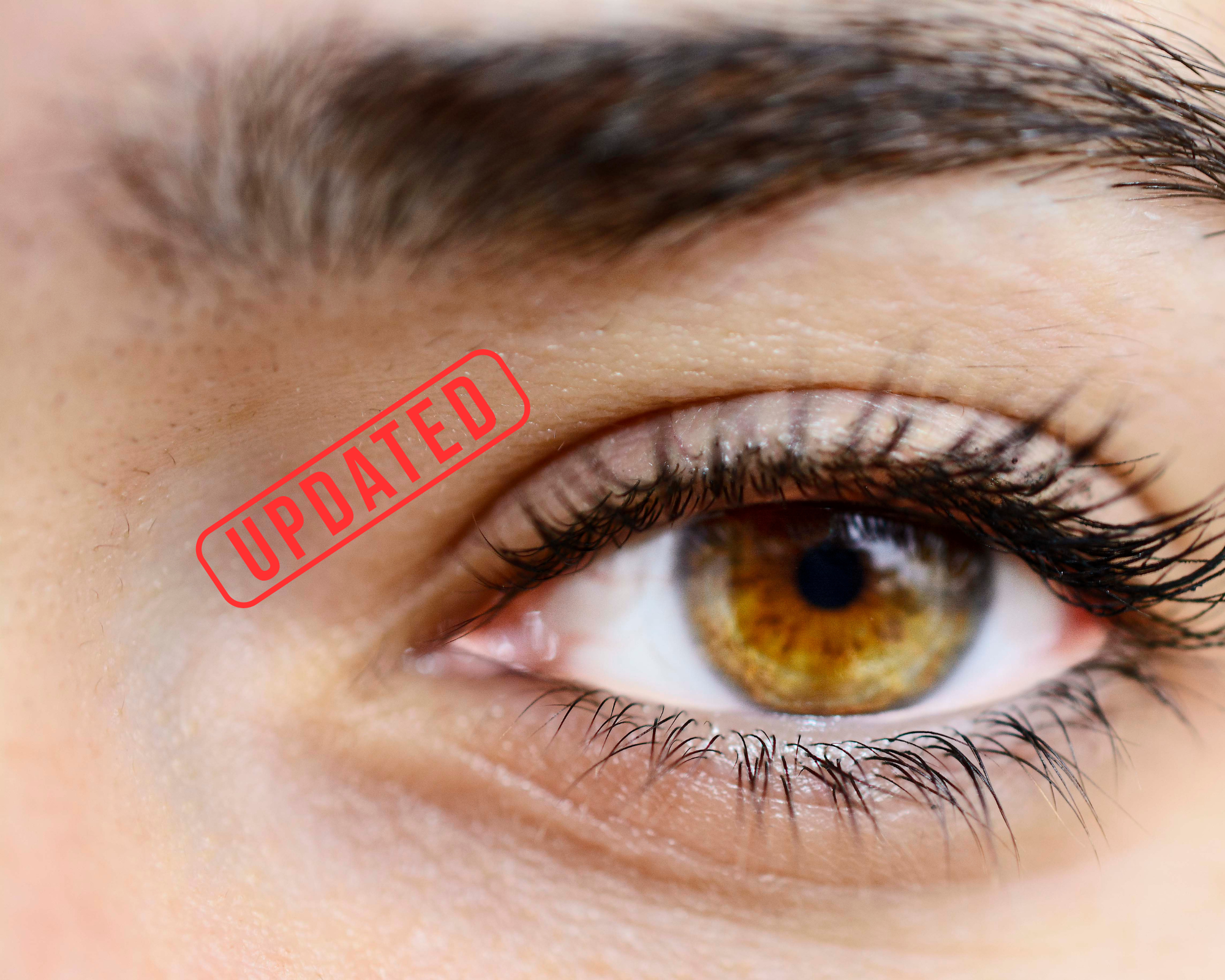 Visual loss secondary to cosmetic filler injection